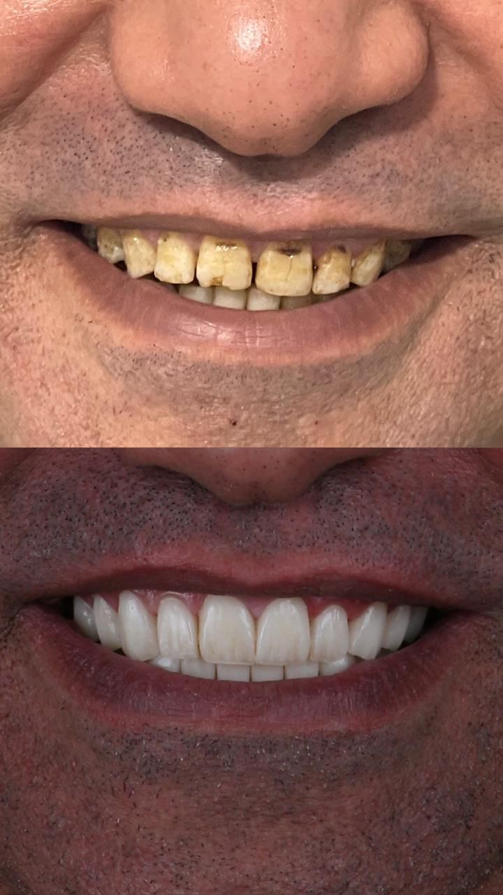 Smile Makeover Case 2
