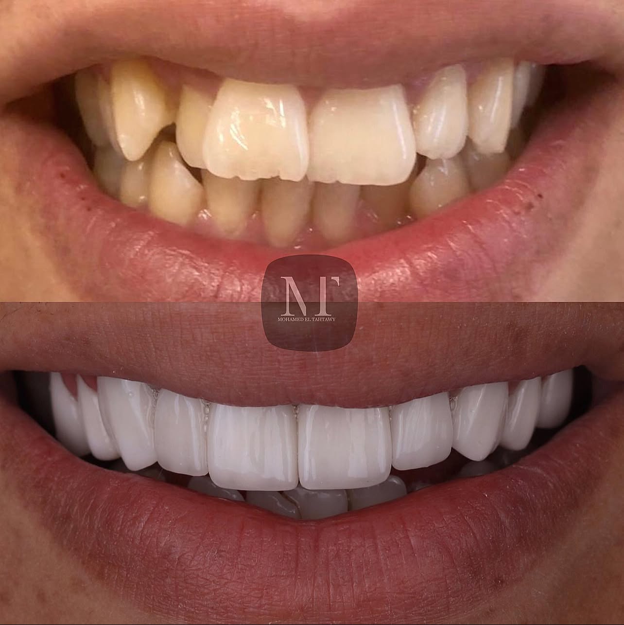 Smile Makeover Case 3
