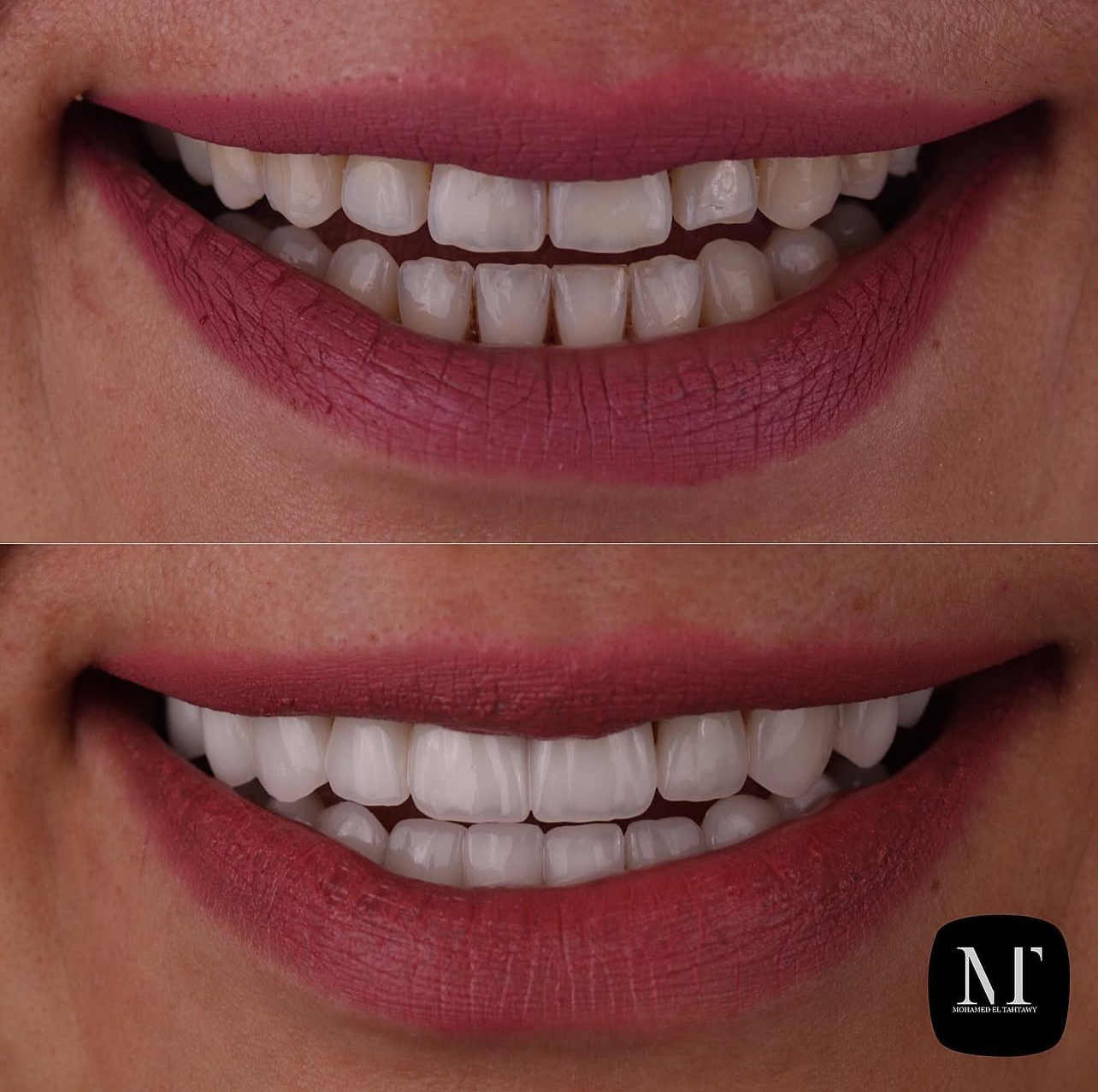 Case 1 - Smile Makeover
