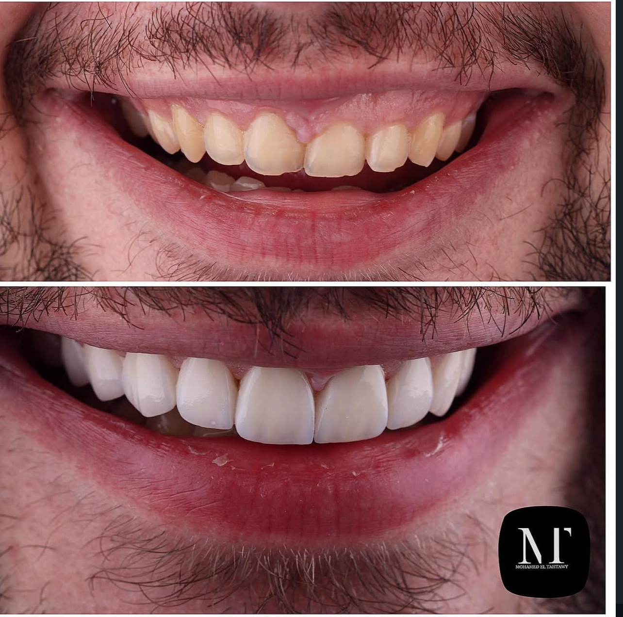 Smile Makeover Case 4